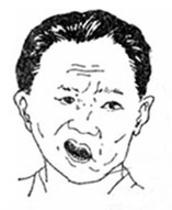 砭石療法驅風活絡醫治面癱效果顯著