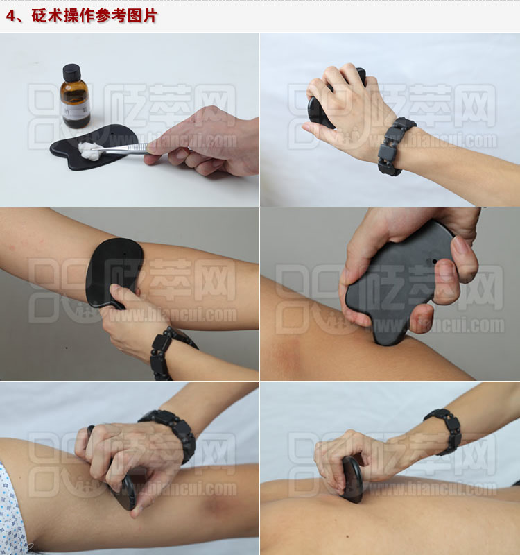 砭術操作參考圖片